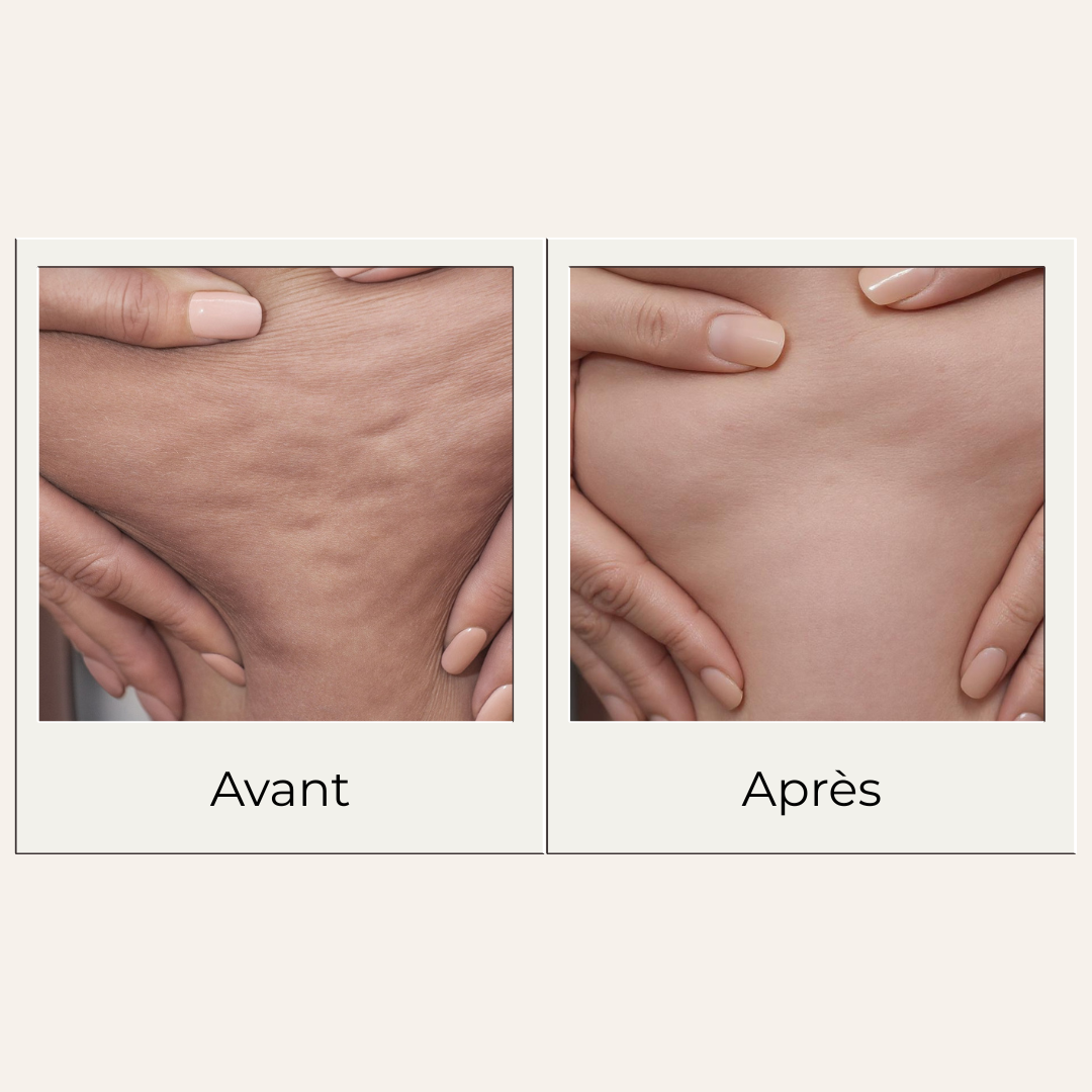 Avant après montrant les effets possibles d'un massage régulier avec le gua sha en bois de hêtre sur cuisse