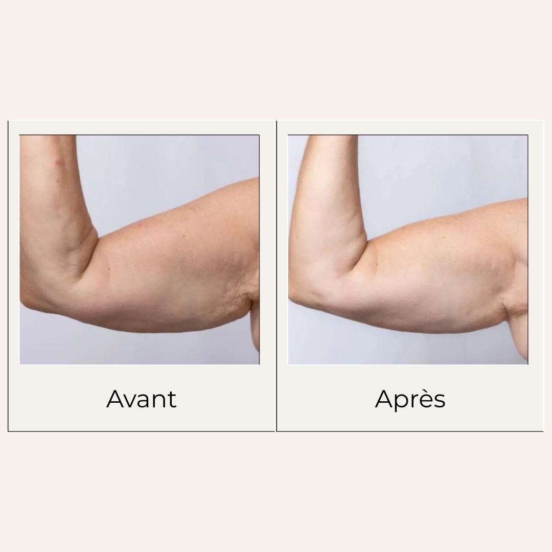 Avant après montrant les effets possibles d'un massage régulier avec le gua sha en bois de hêtre sur avant bras