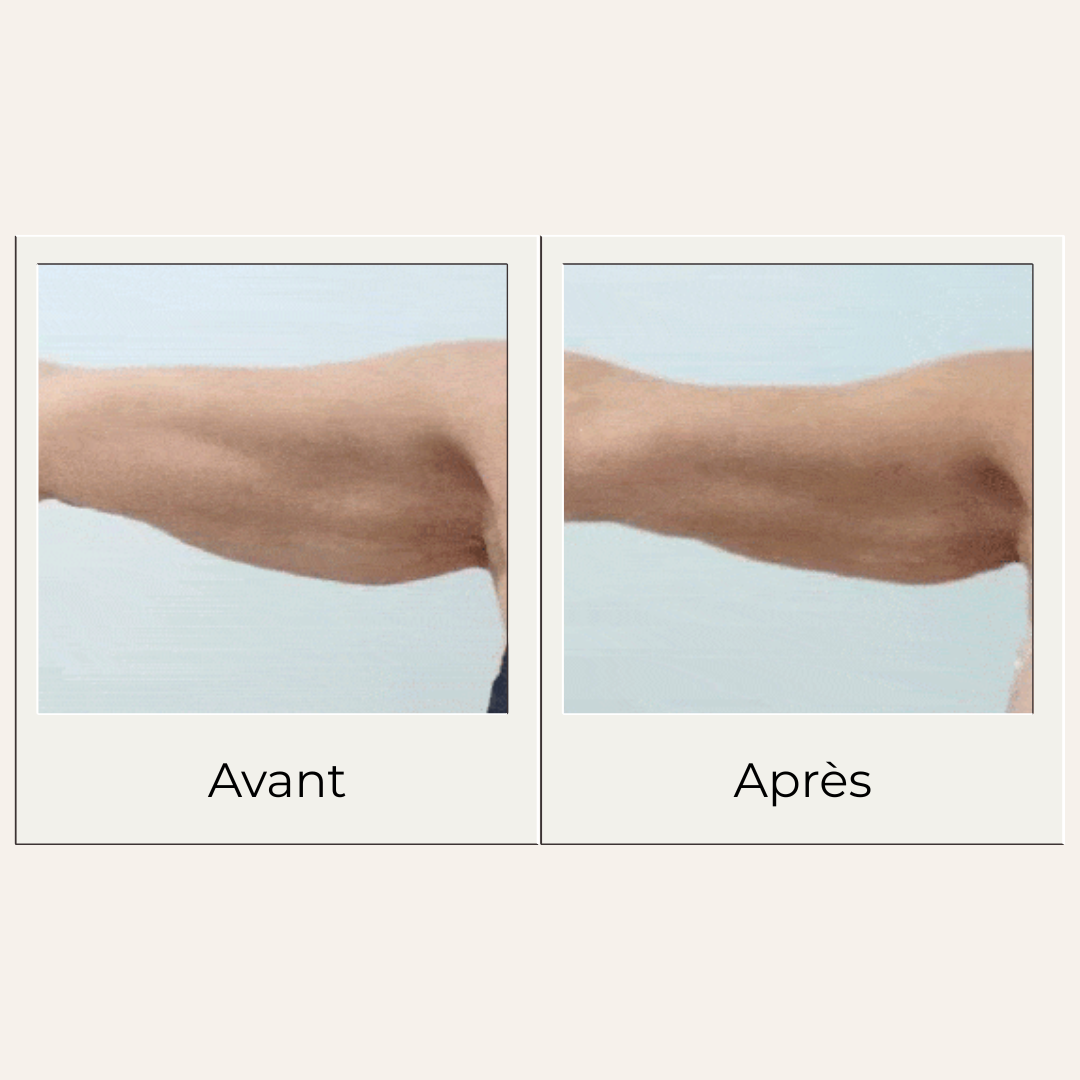 Avant après montrant les effets possibles d'un massage régulier avec le gua sha en bois de hêtre sur bras