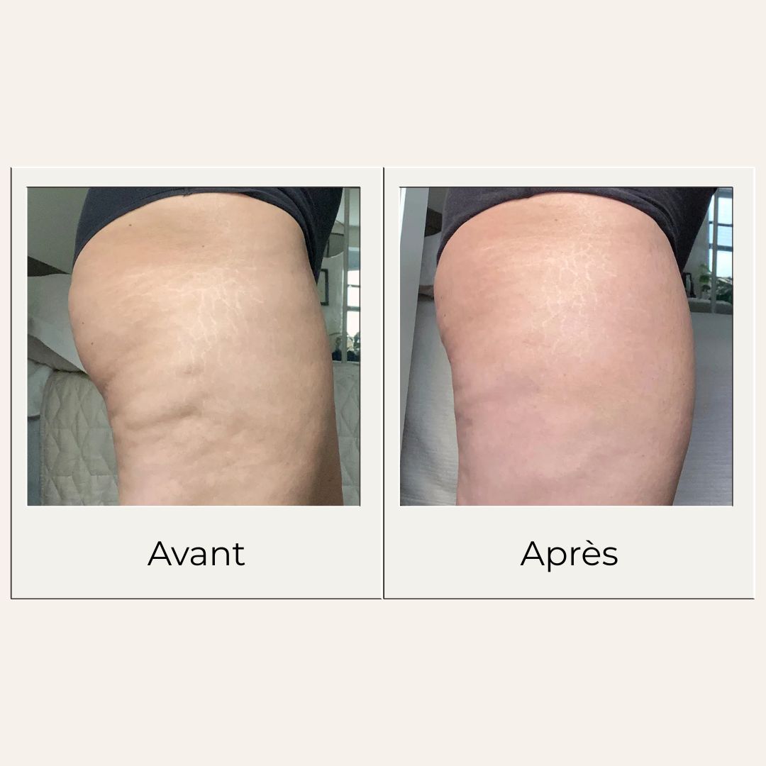 Avant après montrant les effets possibles d'un massage régulier avec le gua sha en bois de hêtre sur haut cuisse
