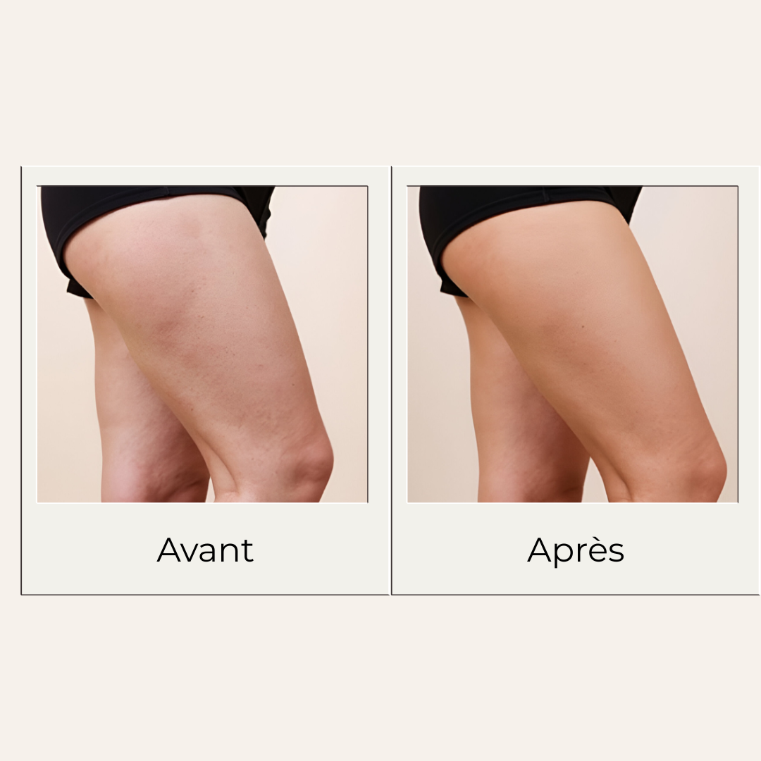 Avant après montrant les effets possibles d'un massage régulier avec le gua sha en bois de hêtre sur cuisses