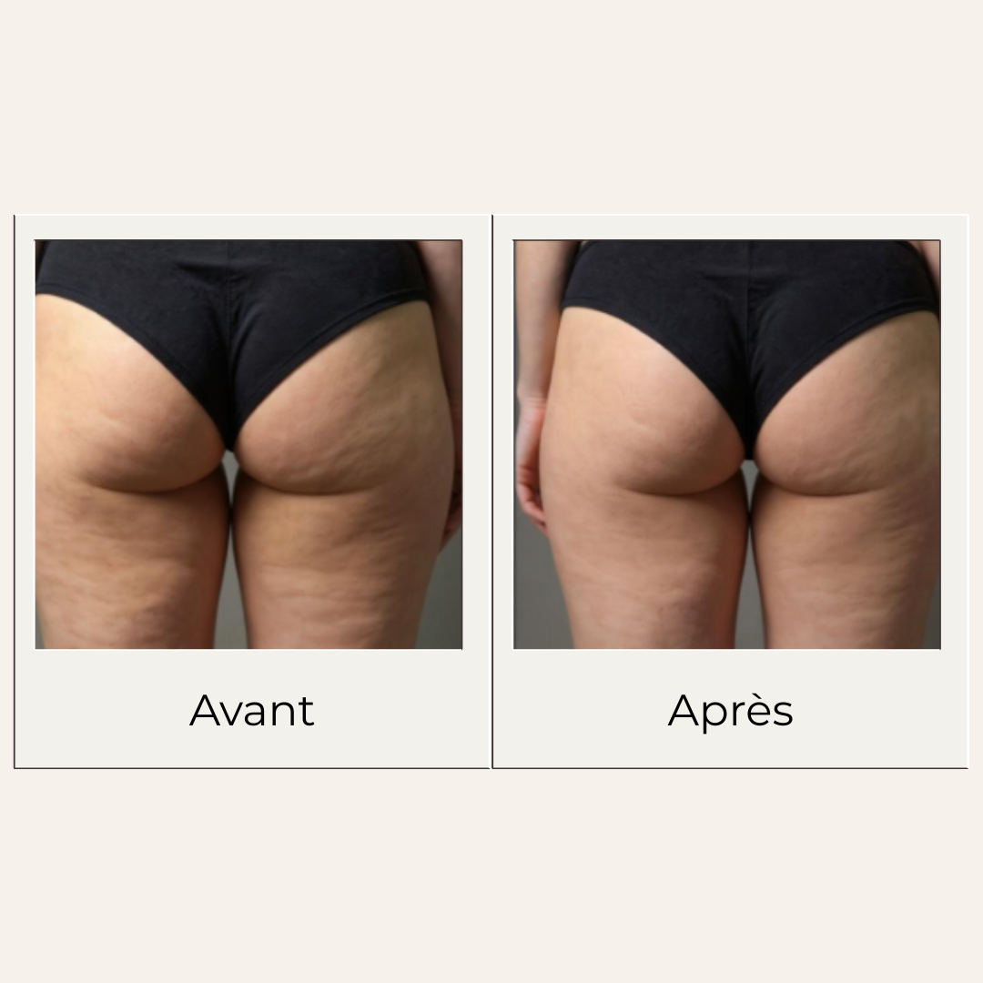 Avant après montrant les effets possibles d'un massage régulier avec le gua sha en bois de hêtre sur fesses