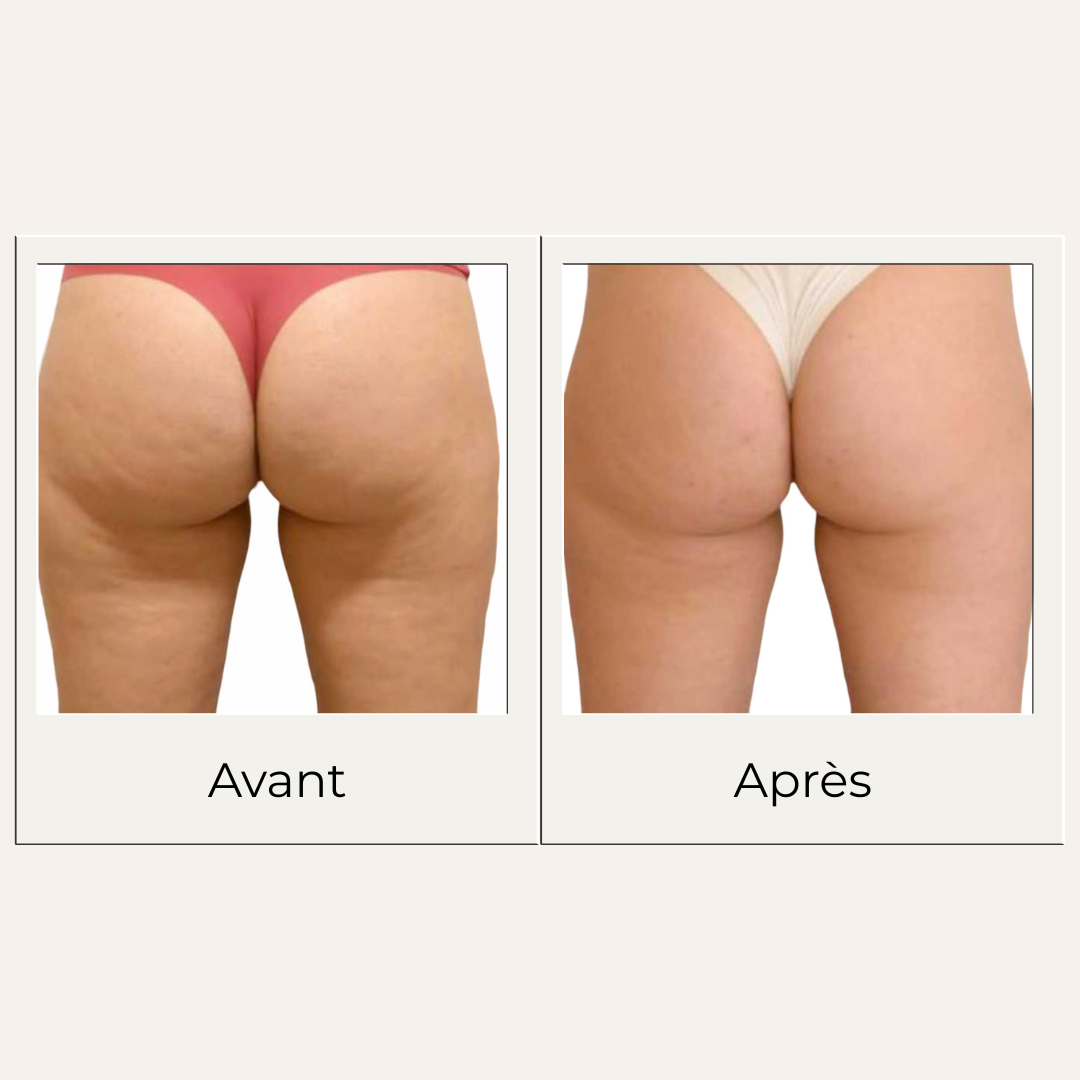 Avant après montrant les effets possibles d'un massage régulier avec le gua sha en bois de hêtre sur fessiers
